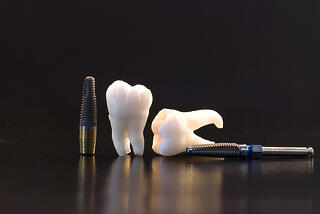 bigstock-Human-Teeth--Dental-Implant-A-5393220