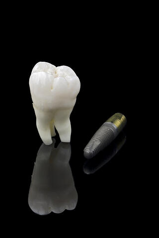 replacing missing teeth