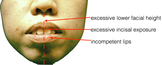 bimaxillary_protrusion_1.png