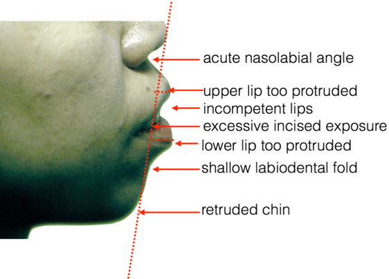 bimaxillary_protrusion_2.png
