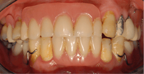 full_mouth_implants_1-1.png