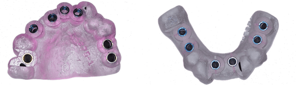 full_mouth_implants_5.png