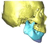 genioplasty_2.png