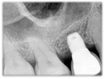 short_implant_3.png