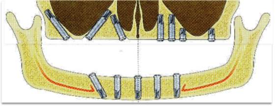 tilted_implant.png