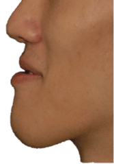 underbite_photo.png