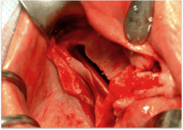 zygomatic_implant_2.png
