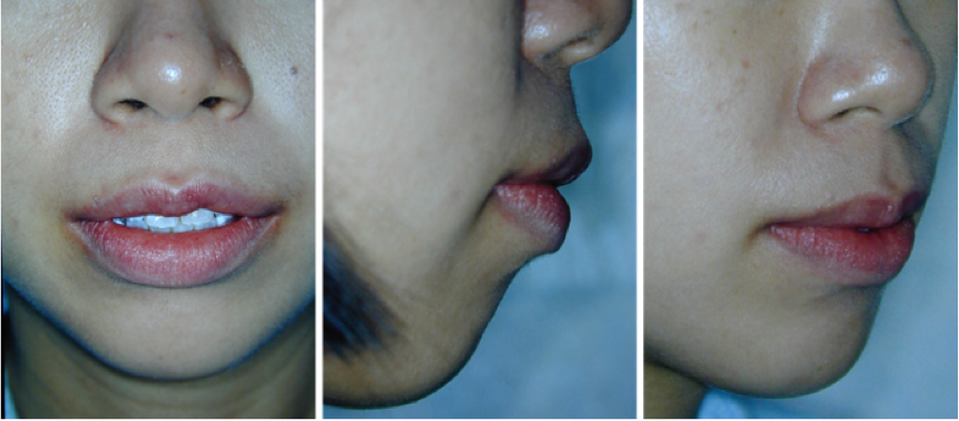 bimaxillary_protrusion_3.png